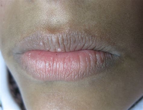 hpv warts on lips pictures